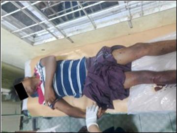 Innocent civilians injured in drone bombs and improvised rockets attacks in Pa Htoe Phyu Ward, Salin Township of Magway Region.