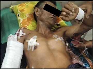 Innocent Civilian Injured in Heavy Weapon Attack by Armed Terrorists in Htantabin Township of Bago Region.