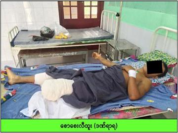 Innocent Civilian Injured in Heavy Weapon Attack by Armed Terrorists in Dawei Township of Tanintharyi Region