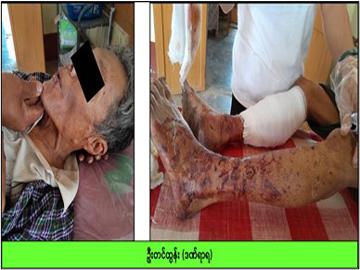 Innocent Civilian Injured After Stepping on Explosive Device Planted by so-called PDF terrorists in Minhla Township of Magway Region.