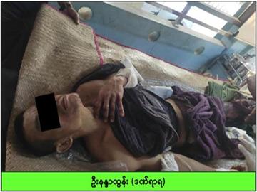 Innocent Civilian Injured in Explosion by KNU Members Supporting Terrorism and So-called PDF Terrorists in Thanbyuzayet Township of Mon State.
