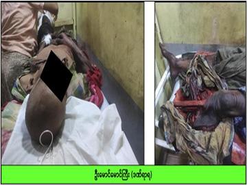 Innocent Civilian Injured After Stepping on Explosive Device Planted by AA so-called PDF terrorists in Thabung Township of Ayeyarwady Region.