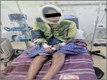 A civil servant and woman injured by heavy weapon shell explosion in Ma Lal Village, Natogyi Township of Mandalay Region.