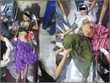 မကွေးတိုင်းဒေသကြီး၊ ပခုက္ကူမြို့နယ်၌ PDF အမည်ခံ အကြမ်းဖက်အဖွဲ့က ကျေးရွာအတွင်းသို့ Drop Bomb များ ပစ်ချတိုက်ခိုက်ခဲ့မှုကြောင့် ကလေးငယ်တစ်ဦးအပါအဝင် အပြစ်မဲ့ အရပ်သားပြည်သူ နှစ်ဦး ထိခိုက်ဒဏ်ရာရရှိမှု မှတ်တမ်းဓာတ်ပုံ။