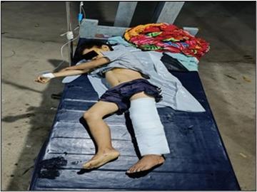 ကချင်ပြည်နယ်၊ ဝိုင်းမော်မြို့နယ်၌ KIA လက်နက်ကိုင်သောင်းကျန်းသူအဖွဲ့နှင့် PDF အမည်ခံ အကြမ်းဖက်သမားများ ပူးပေါင်းအဖွဲ့က ကျေးရွာအတွင်းသို့ လက်နက်ကြီးဖြင့် ပစ်ခတ်တိုက်ခိုက်ခဲ့မှုကြောင့် ကလေးငယ် တစ်ဦး ထိခိုက်ဒဏ်ရာရရှိမှု မှတ်တမ်းဓာတ်ပုံ။