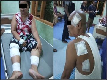 ပဲခူးတိုင်းဒေသကြီး၊ ကျောက်တံခါးမြို့နယ်၌ PDF အမည်ခံ အကြမ်းဖက်သမားများက လက်ပစ်ဗုံးဖြင့် ပစ်ပေါက်ခဲ့မှုကြောင့် အပြစ်မဲ့ အရပ်သားပြည်သူ နှစ်ဦး ထိခိုက်ဒဏ်ရာရရှိမှု မှတ်တမ်းဓာတ်ပုံ။