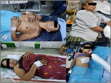 မန္တလေးတိုင်းဒေသကြီး၊ ပုသိမ်ကြီးမြို့နယ်၌ အကြမ်းဖက်အဖွဲ့(စိစစ်ဆဲ)က ကျေးရွာအတွင်းသို့ လက်နက်ကြီးဖြင့် ပစ်ခတ်တိုက်ခိုက်ခဲ့မှုကြောင့် ကလေးငယ် တစ်ဦး အပါအဝင် အပြစ်မဲ့ အရပ်သားပြည်သူ လေးဦး ထိခိုက်ဒဏ်ရာရရှိမှု မှတ်တမ်းဓာတ်ပုံ။