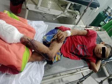 Child Injured After Stepping Explosive Device Planted by So-called PDF Terrorist Group in Yebyu Township of Tanintharyi Region