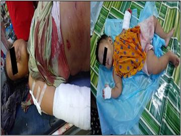 ကရင်ပြည်နယ်၊ ကော့ကရိတ်မြို့နယ်၌ အကြမ်းဖက်အဖွဲ့(စိစစ်ဆဲ)က ရပ်ကွက်အတွင်းသို့ လက်နက်ကြီးဖြင့် ပစ်ခတ်တိုက်ခိုက်ခဲ့မှုကြောင့် ကလေးငယ် တစ်ဦး အပါအဝင် အပြစ်မဲ့ အရပ်သားပြည်သူ နှစ်ဦး ထိခိုက်ဒဏ်ရာရရှိမှု မှတ်တမ်းဓာတ်ပုံ။