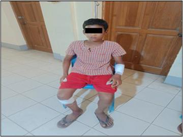 စစ်ကိုင်းတိုင်းဒေသကြီး၊ ကန့်ဘလူမြို့နယ်၌ PDF အမည်ခံ အကြမ်းဖက်အဖွဲ့ထောင်ထားသည့် လက်လုပ်မိုင်းတစ်လုံးပေါက်ကွဲခဲ့မှုကြောင့် အပြစ်မဲ့ ကလေးငယ်တစ်ဦးထိခိုက်ဒဏ်ရာရရှိ