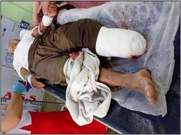 Innocent Civilian Injured After Stepping on Explosive Device Planted by Terrorist Group in Hpa-An Township of Kayin State