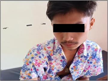 An innocent civilian injured in an attack by a so-called PDF terrorist group in Tanintharyi Township of Tanintharyi Region.