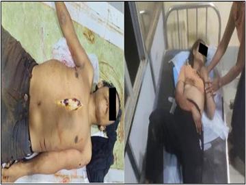 Innocent Civilian Shot Dead, Another Injured by Pro-Terrorism KUN Members and So-Called PDF Terrorists in Shwegyin Township of Bago Region.