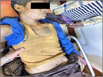 Innocent Civilian Sustains Gunshot Wounds by So-Called PDF Terrorists in Taungoo Township of Bago Region.