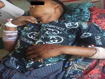 မကွေးတိုင်းဒေသကြီး၊ စလင်းမြို့နယ်၌ PDF အမည်ခံ အကြမ်းဖက်အဖွဲ့ထောင်ထားသည့် နင်းမိုင်း တစ်လုံး ပေါက်ကွဲမှုကြောင့် အပြစ်မဲ့ အရပ်သားပြည်သူ တစ်ဦး ထိခိုက်ဒဏ်ရာရရှိမှု မှတ်တမ်းဓာတ်ပုံ။