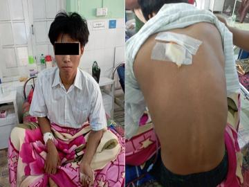 Innocent Civilian Injured in Attack by So-Called PDF Terrorists in Monywa Township of Sagaing Region