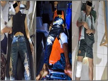 An innocent civilian was killed, and three others along with a security personnel were injured in a mine explosion planted by pro-terrorism KNU members and so-called PDF terrorists in Bilin Township of Mon State.