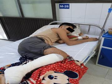 Innocent Civilian Injured in Heavy Weapon Attack by Terrorist Group in Naungcho Township of Northern Shan State