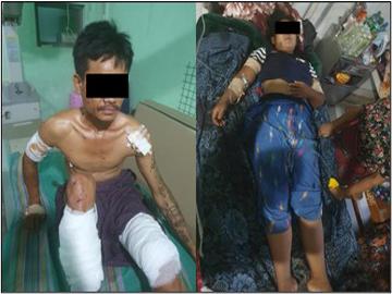 Two innocent civilians were injured after stepping on an explosive device planted by a so-called PDF terrorist group in Shwebo Township of Sagaing Region.