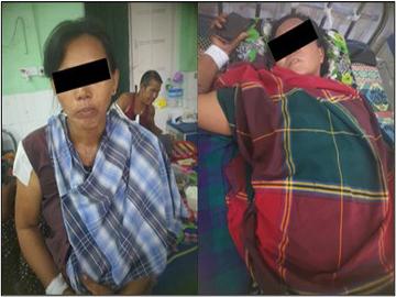 Two innocent civilians were injured in a heavy weapon attack by a terrorist group in Ayardaw Township of Sagaing Region.
