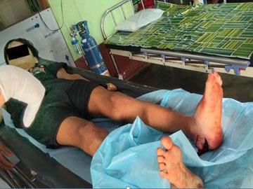 An innocent civilian injured in a heavy weapon attack by a terrorist group in Kawkareik Township of Kayin State.