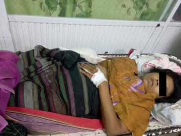 A woman injured in an attack by a so-called PDF terrorist group in Tada-U Township of Mandalay Region.