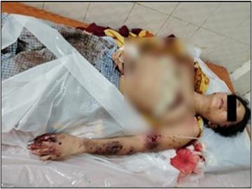  An innocent civilian injured by explosion of unexploded rocket shell in  Oakpho Township of Bago Region.