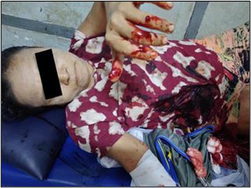 Three innocent civilians injured in a heavy weapon attack by pro-terrorism KNU members and so-called PDF terrorists in Kawkareik Township of Kayin State.