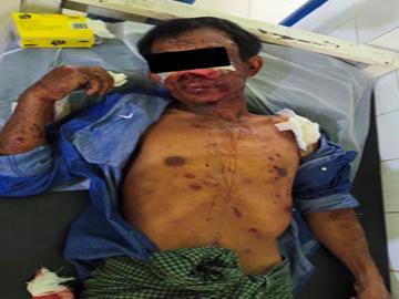 An innocent civilian injured after stepping on a land mine planted by a so-called  PDF terrorist group in Salin Township of Magway Region.