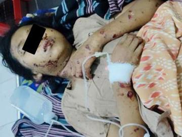Two innocent civilians injured after stepping on an explosive device planted by a terrorist group in Nyaung-U Township of Mandalay Region.