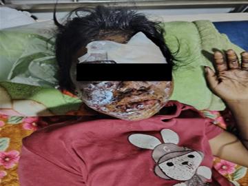 An innocent civilian injured by explosive device planted by a pro-terrorism armed insurgent group in Hsipaw Township of Shan State.