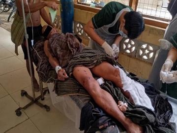   An innocent civilian was injured after stepping on an explosive device planted  by a so-called PDF terrorist group in Sidoktaya Township of Magway Region. 