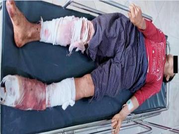 Innocent Civilian Injured in Heavy Weapon Attack by Ta’ang National Liberation Army (TNLA) Terrorist Group and So-Called PDF Terrorists in Naungcho Township of Northern Shan State 03 July 2025      Terrorists are ruthlessly carrying out abductions, killings and armed attacks, using both heavy and small weapons, on wards and villages, as well as conducting drone strikes, all with the intent to harm civilians and spread fear. They are also indiscriminately planting landmines on public roads, targeting governm