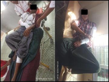 Two Innocent Civilians Injured After Stepping Explosive Device Planted by So-Called PDF Terrorist Group in Salin Township, Magway Region