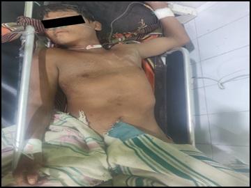 An innocent civilian injured after stepping on a land mine planted by a so-called  PDF terrorist group in Salin Township of Magway Region.