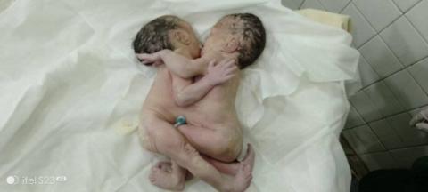 Bilin Hospital delivers conjoined twins by Caesarean Section