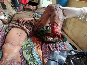 Innocent Civilian Injured After Stepping Explosive Device Planted by So-Called PDF Terrorist Group in Sidoktaya Township, Magway Region