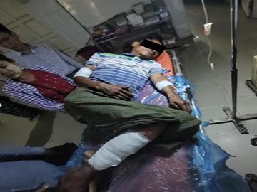 An innocent civilian injured after stepping on a land mine planted by a so-called PDF terrorist group in Salin Township of Magway Region.