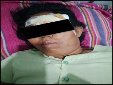 Innocent Civilian Injured in Heavy Weapon Attacks by So-Called PDF Terrorist Group in Taungtha Township of Mandalay Region