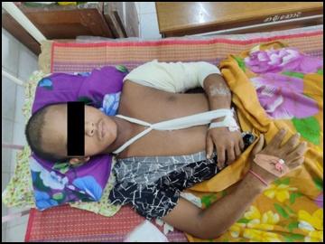 Innocent Civilian injured in heavy weapon attack by a so-called PDF terrorist group in Launglon Township of Tanintharyi Region.