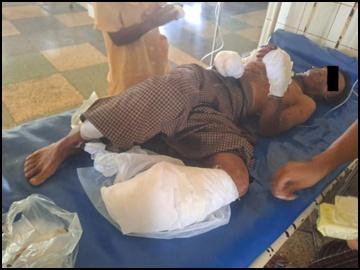 Innocent Civilian Injured After Stepping Explosive Device Planted by So-Called PDF Terrorist Group in Lashio Township of Shan State